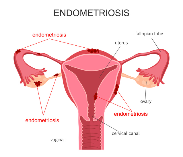endometriose afbeelding met bloemen