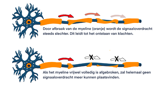 myelineschade illustratie